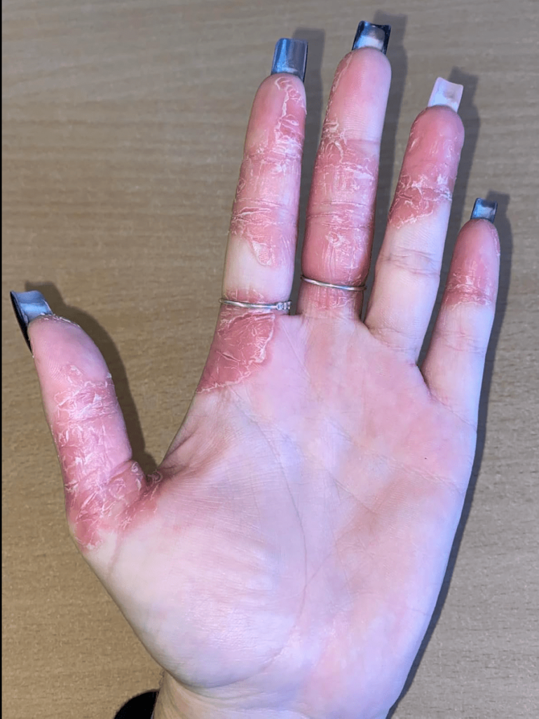 Мазь от псориаза отзывы