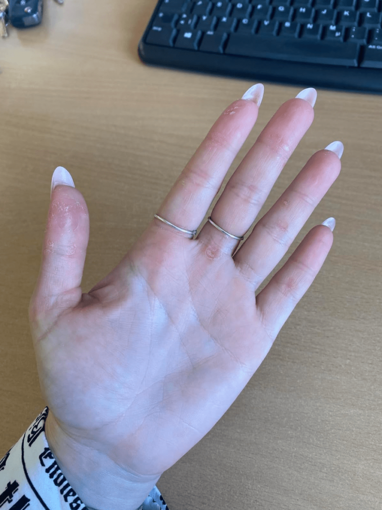 Мазь от псориаза отзывы