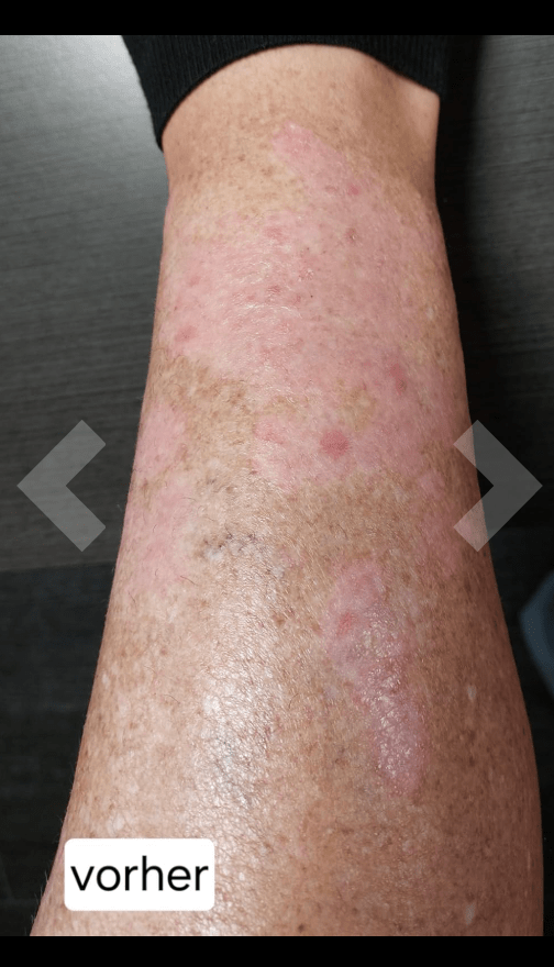 Sorion Repair Cream - мазь от псориаза