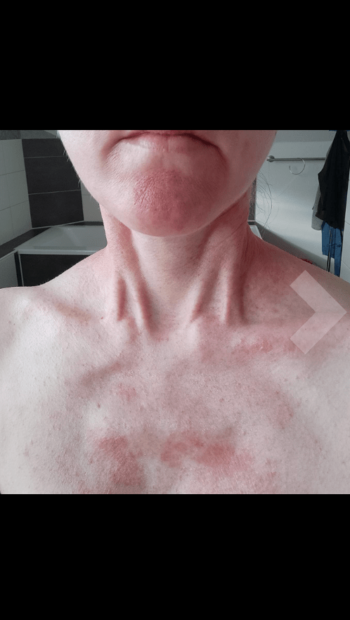 Мазь от псориаза отзывы