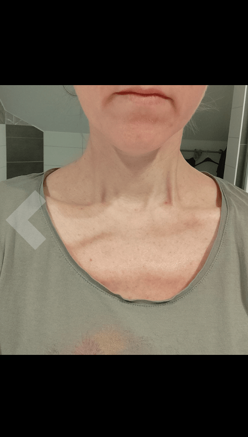 Мазь от псориаза отзывы