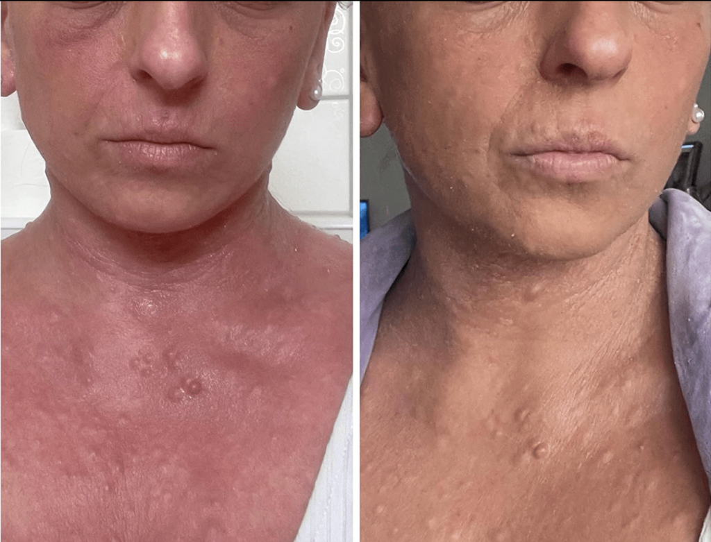 Sorion Repair Cream Sensitive - крем от псориаза