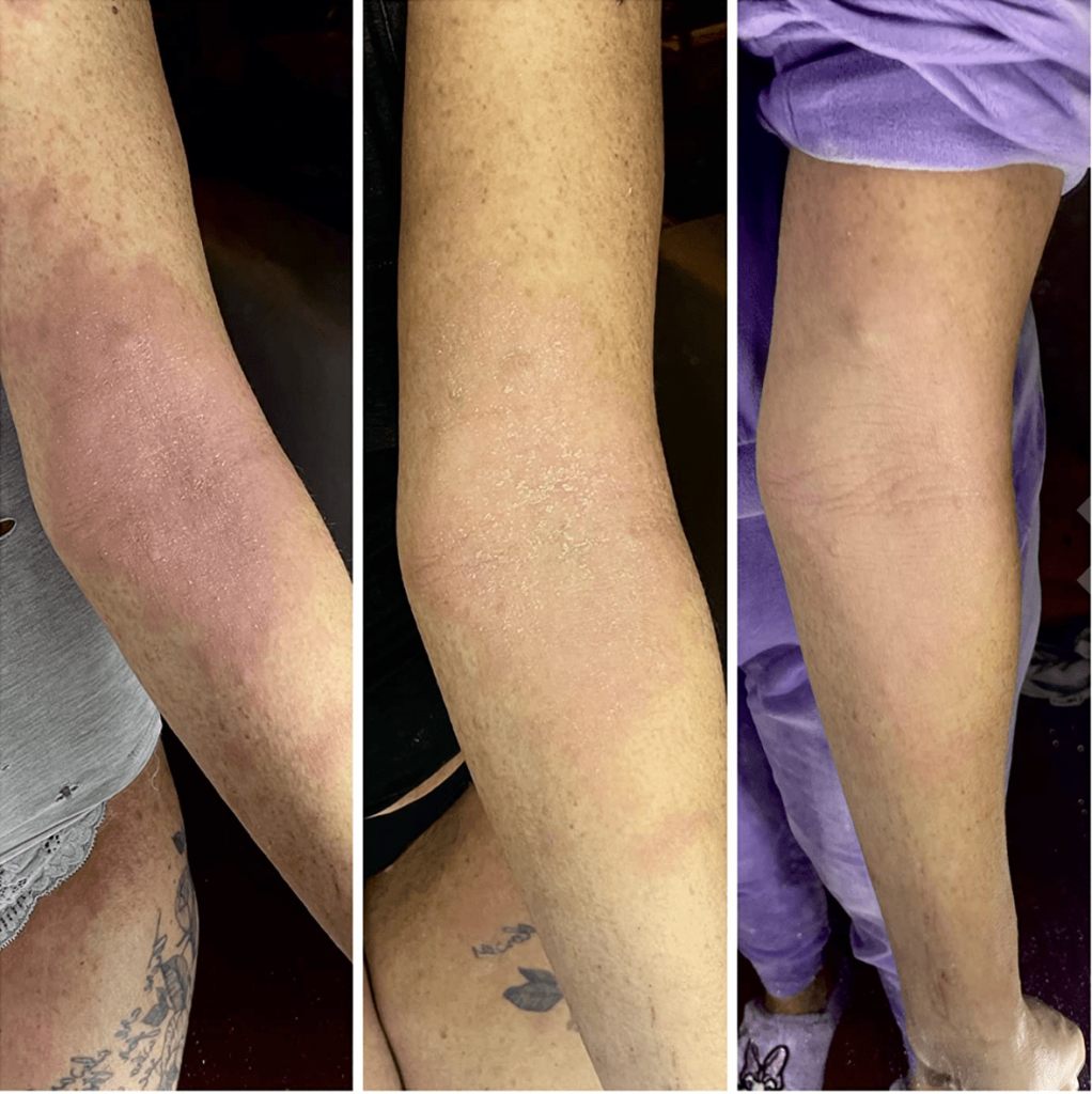 Sorion Repair Cream Sensitive - крем от псориаза