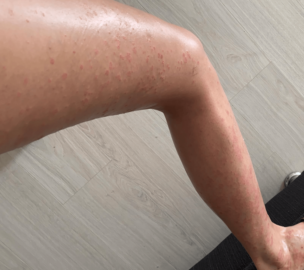 Мазь от псориаза отзывы