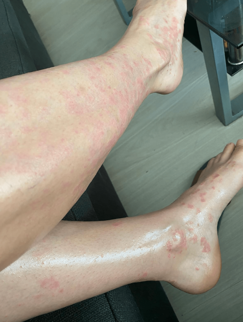 Мазь от псориаза отзывы