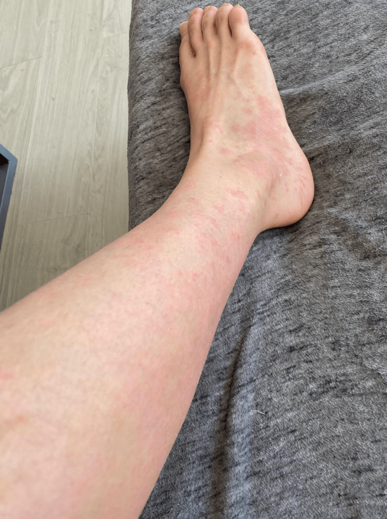 Мазь от псориаза отзывы