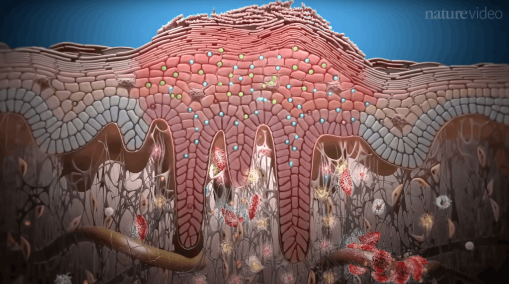 развитие воспаления при псориазе