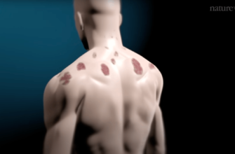 псориазные бляшки