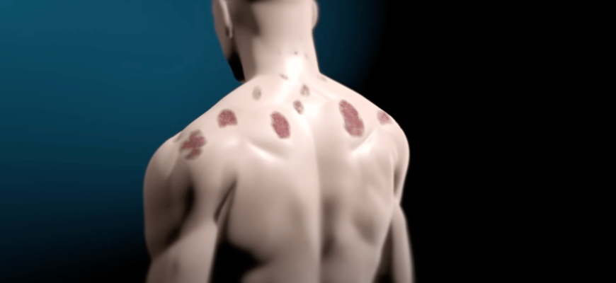 псориазные бляшки